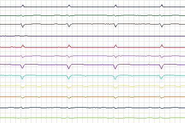 s0216lre-patient058 thumbnail