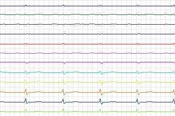 s0274lre-patient170 thumbnail