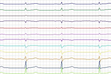s0275lre-patient166 thumbnail
