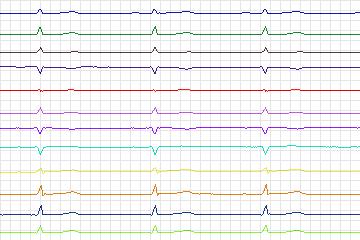s0287lre-patient150 thumbnail
