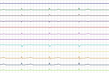 s0300lre-patient174 thumbnail