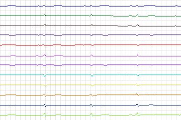 s0303lre-patient105 thumbnail