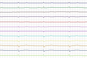 s0304lre-patient172 thumbnail