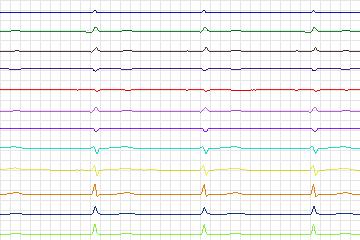 s0306lre-patient104 thumbnail
