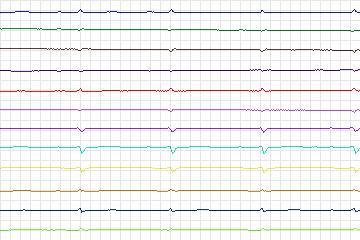 s0307lre-patient141 thumbnail