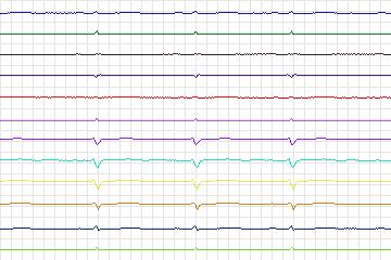 s0314lre-patient049 thumbnail