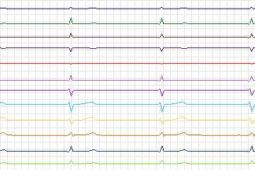 s0323lre-patient165 thumbnail