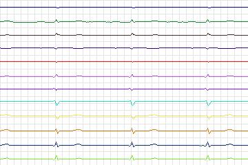 s0324lre-patient174 thumbnail