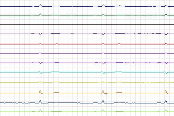 s0328lre-patient169 thumbnail