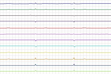 s0329lre-patient169 thumbnail