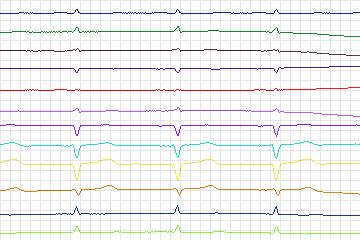 s0342lre-patient127 thumbnail
