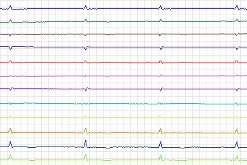 s0344lre-patient089 thumbnail