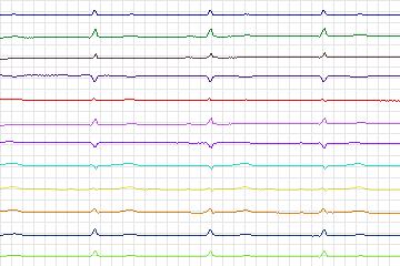 s0345lre-patient085 thumbnail
