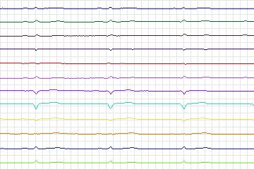s0347lre-patient042 thumbnail