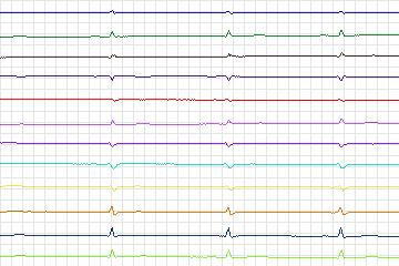 s0352lre-patient088 thumbnail