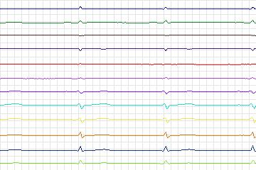 s0356lre-patient090 thumbnail