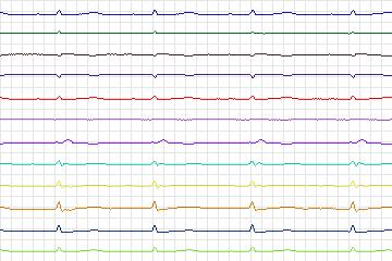 s0364lre-patient171 thumbnail