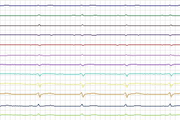 s0369lre-patient095 thumbnail