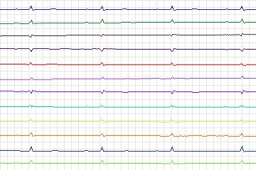 s0372lre-patient089 thumbnail