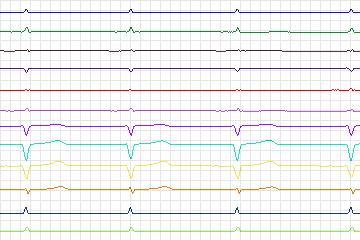 s0383lre-patient127 thumbnail