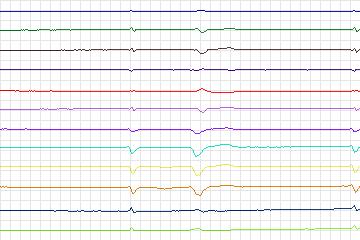 s0384lre-patient097 thumbnail