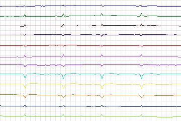 s0387lre-patient099 thumbnail