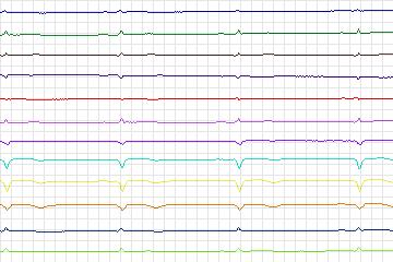 s0397lre-patient099 thumbnail