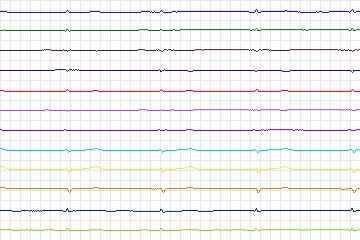 s0398lre-patient098 thumbnail