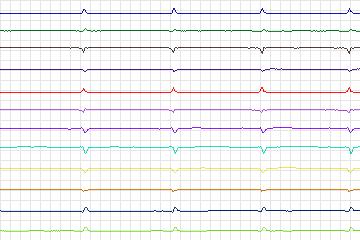 s0401lre-patient100 thumbnail