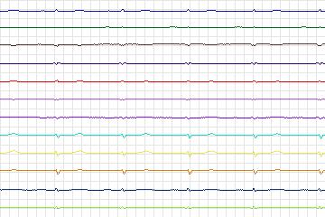 s0409lre-patient098 thumbnail