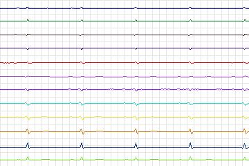 s0413lre-patient088 thumbnail