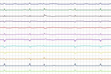 s0416lre-patient102 thumbnail